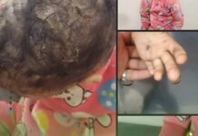 طفلة في إب تتعرض لتعذيب مروّع لمدة خمسة أشهر على يد خالتها