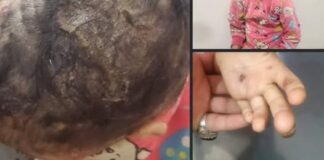 طفلة في إب تتعرض لتعذيب مروّع لمدة خمسة أشهر على يد خالتها